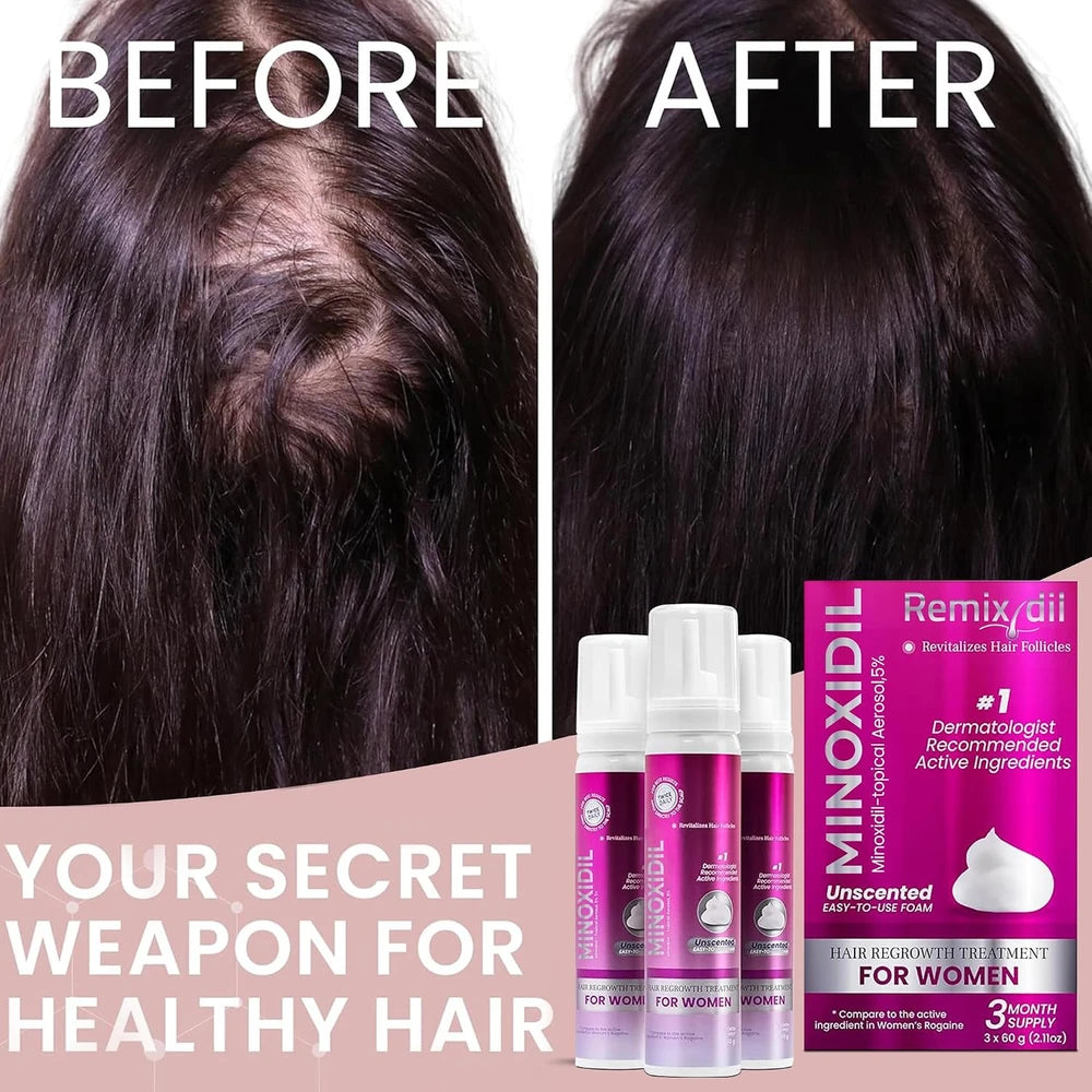 Minoxidil Women Hair Regrowth Treatment Foam