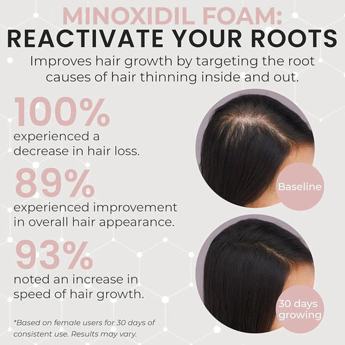 Minoxidil Women Hair Regrowth Treatment Foam