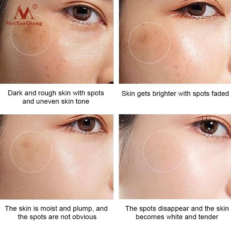 Powerful Whitening Freckle Cream Remove